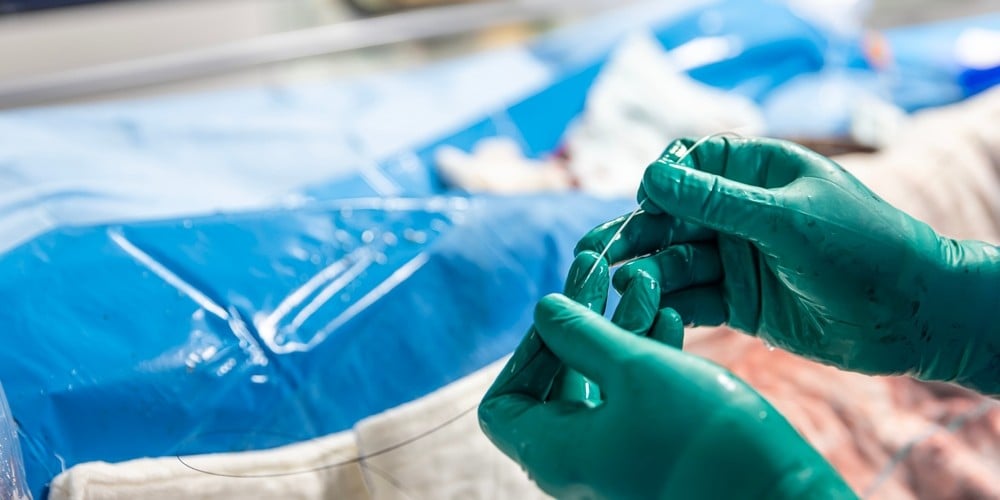 A surgeon goes to place a metal stent into a patient on the operating table.