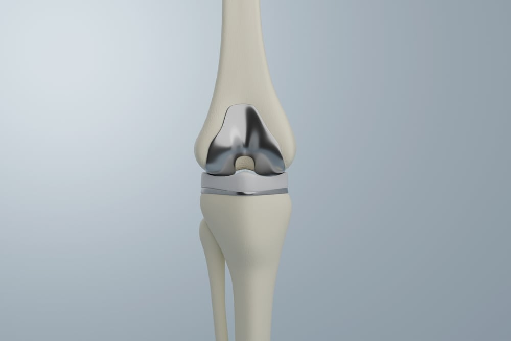 A knee replacement with a focus on the metal-based parts of the implant.